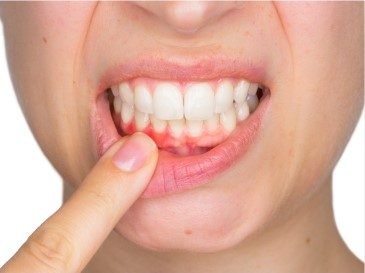 person pointing to bleeding gums