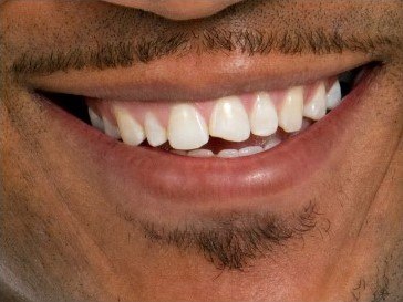 person with chipped tooth